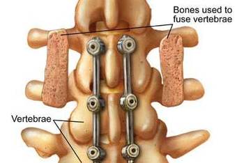 Hdg7_spinalfusion_crop_340x234
