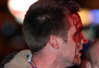 MANCHESTER, UNITED KINGDOM - MAY 14:  A bloody faced Ranger's fan looks on after police charged frustrated supporters in Piccadilly Gardens, after the giant TV screens failed  for the Uefa Cup final May 14, 2008 in Manchester, England. Thousands of fans descended on the city as their team took on Zenit St Petersburg in the Ibrox club's first European final since the Cup-Winners' Cup win in 1972. Zenit won the game 2-0.  (Photo by Christopher Furlong/Getty Images)