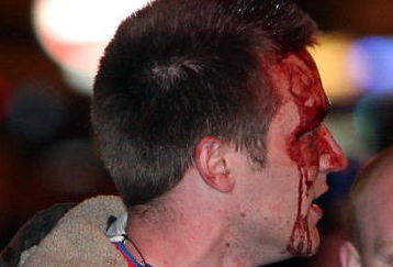 MANCHESTER, UNITED KINGDOM - MAY 14:  A bloody faced Ranger's fan looks on after police charged frustrated supporters in Piccadilly Gardens, after the giant TV screens failed  for the Uefa Cup final May 14, 2008 in Manchester, England. Thousands of fans descended on the city as their team took on Zenit St Petersburg in the Ibrox club's first European final since the Cup-Winners' Cup win in 1972. Zenit won the game 2-0.  (Photo by Christopher Furlong/Getty Images)