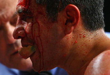 MANCHESTER, UNITED KINGDOM - MARCH 14:   Marc Antonio Barrera bleeds from a cut at the end of the WBA and WBO Inter-Continental Lightweight title fight between Amir Khan and Marc Antonio Barrera at the MEN Arena on March 14, 2009 in Manchester, England. (Photo by Alex Livesey/Getty Images)