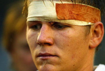 GLASGOW, SCOTLAND - JUNE 23: Australia's battered and bruised Josh Valentine after losing the semi final IRB U21's World Championships match between Australia and Ireland at Hughenden on June 23, 2004 in Glasgow, Scotland.  (Photo by Christopher Furlong/Getty Images)