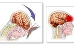 Concussed_crop_150x100