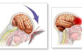 Concussed_crop_340x234